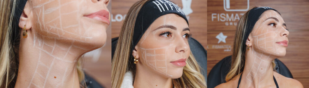 Ultrassom Microfocado e sua Importância na Harmonização Facial