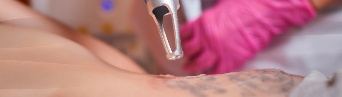CLINIX: Remoção de tatuagem: um dos procedimentos mais procurados
