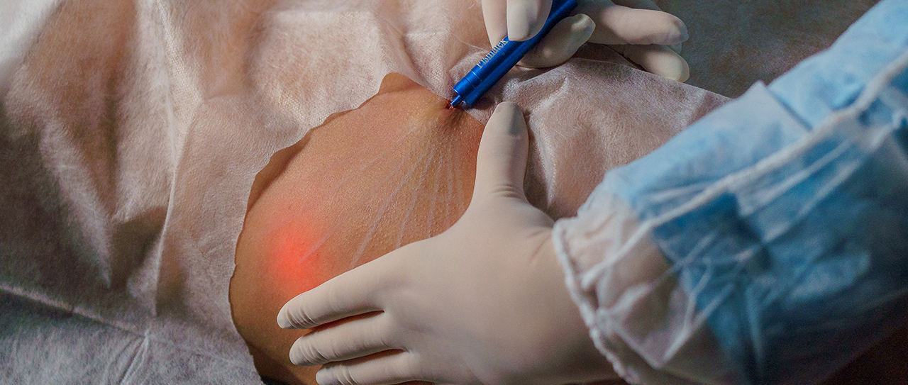 NeoLaser: Remodelação tecidual e rejuvenescimento com precisão óptica de 1470nm!