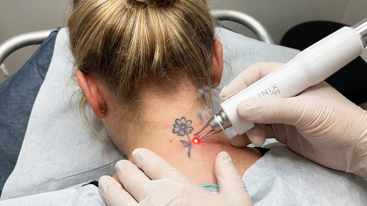 remoção de tatuagem com a texnologia clinix