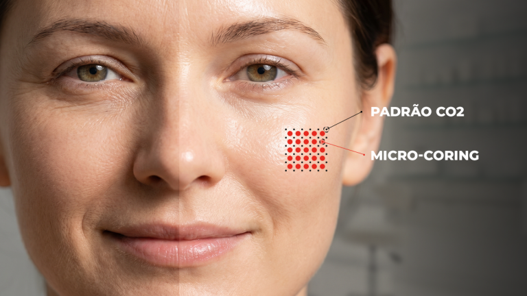 Laser de CO₂ fracionado Reversi — rejuvenescimento e regeneração tecidual rocedimento com laser de CO₂ fracionado para rejuvenescimento facial