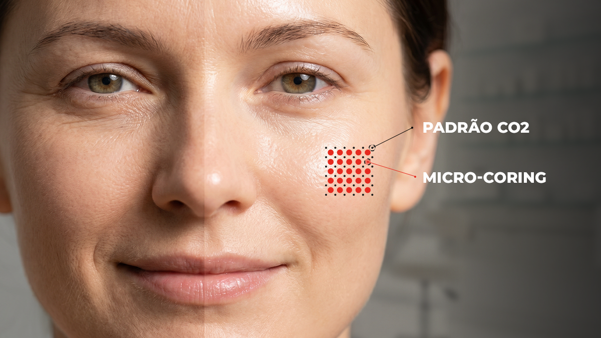 rocedimento com laser de CO₂ fracionado para rejuvenescimento facial
