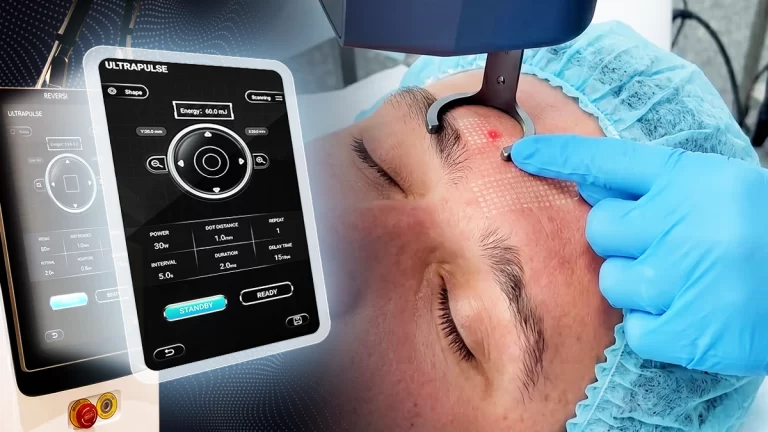 blog-17-06 - Tecnologia CO₂ Ultrapulse copiar